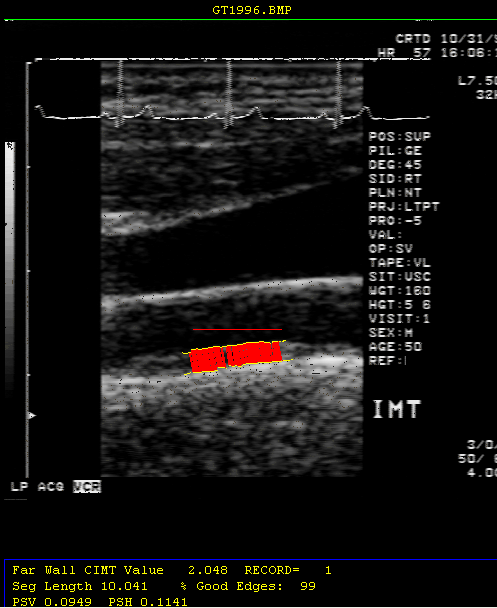 ArterioVision measures the thickness of the first two layers of the carotid artery wall using an ultrasound procedure and advanced image-analysis software.